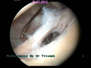 2. same lesion view from top