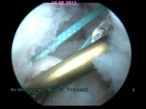 2 Insertion of new ACL with Titanium Imported Endobutton in femoral tunnel to fix ACL at upper end