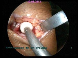 3 insertion of Biodegradable screw at tibial tunnel to fix lower end of ACL