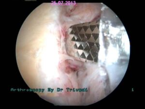 3. cleaning of glenoid socket bone to refreh the edge for sticking of detached bankart lesion