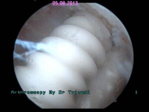 4. femoral tunnel fixation of biodegradable screw