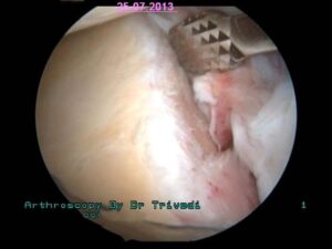 4. cleaning of glenoid socket bone to refreh the edge for sticking of detached bankart lesion