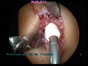 5. Tibial fixation of biodegradable screw