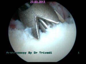 5. arthroscopic fixation of piece of bone with titnium anchors