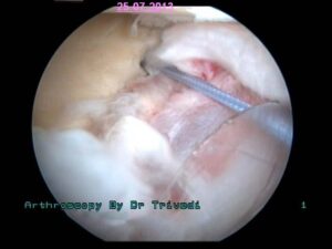 6.such 2 to 4 anchor sutures usde to fixa the bankart's lesion